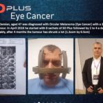 SoPlus seed Eye Cancer
