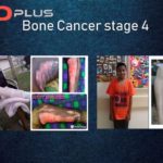 SoPlus seed Bone Cancer
