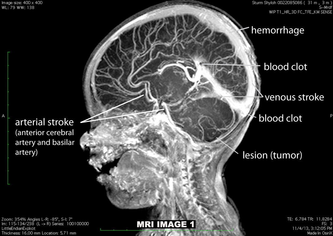 Shyloh DIPG Cancer Survivor Brain Scan