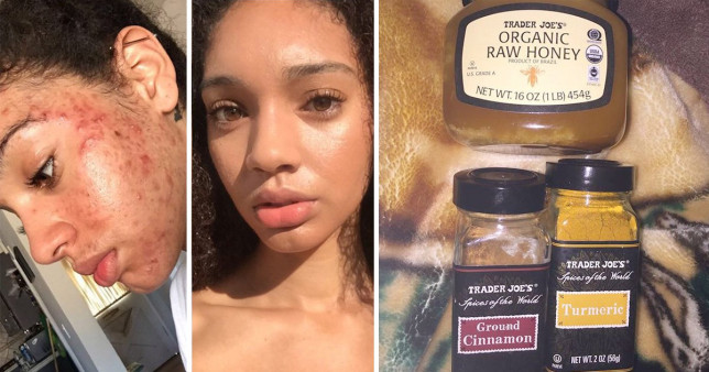 Model Clears Acne With Natural Skin Products From Kitchen